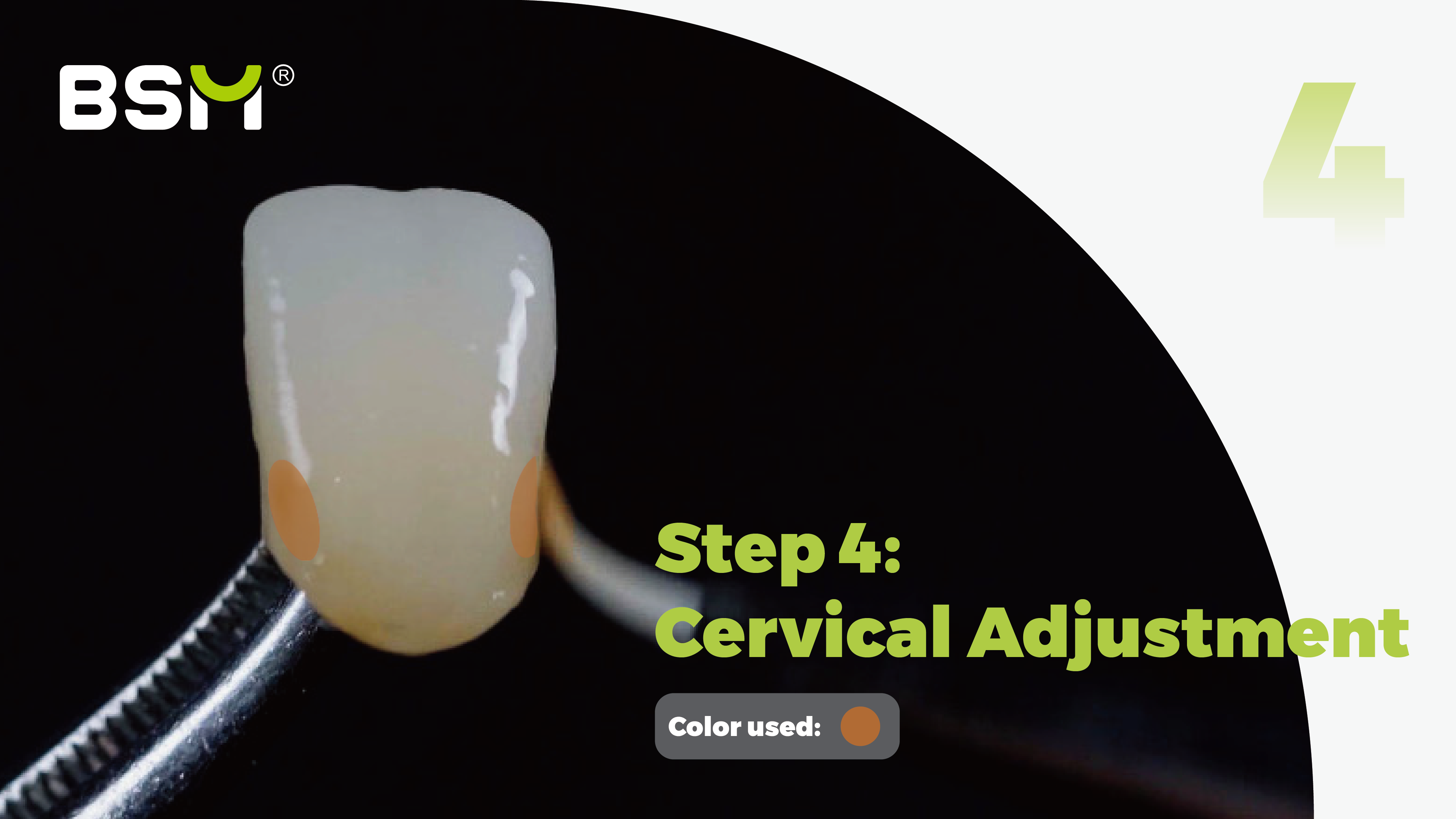dental bonding stains